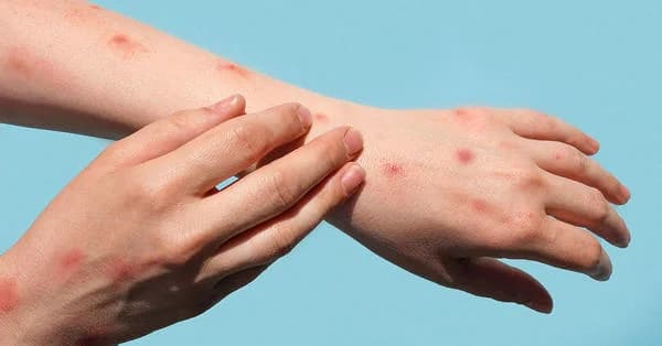 WHO Most Likey To Rename Monkeypox To Mp